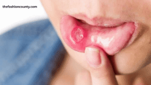 Natural canker sore home remedies including saltwater rinse, honey, and aloe vera gel
